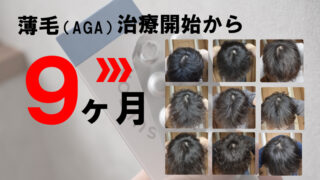 【効果なし？】AGA治療9ヶ月の効果を公開！フィナステリド・ミノキシジルの効果を画像で解説！ 